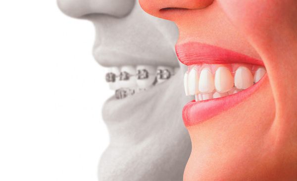 Invisalign: la ortodoncia invisible